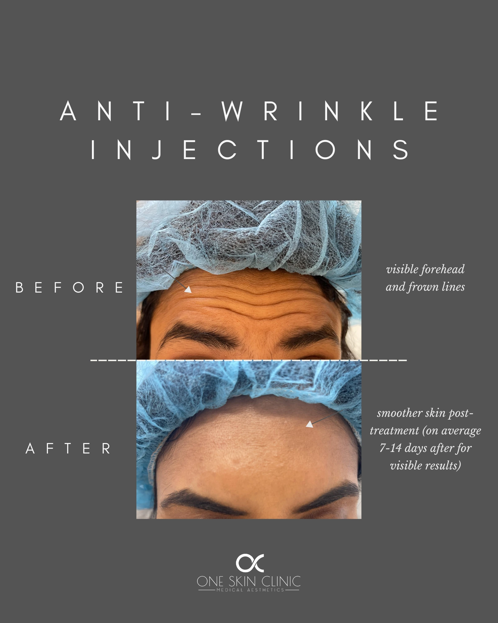 anti wrinkle treatment marylebone