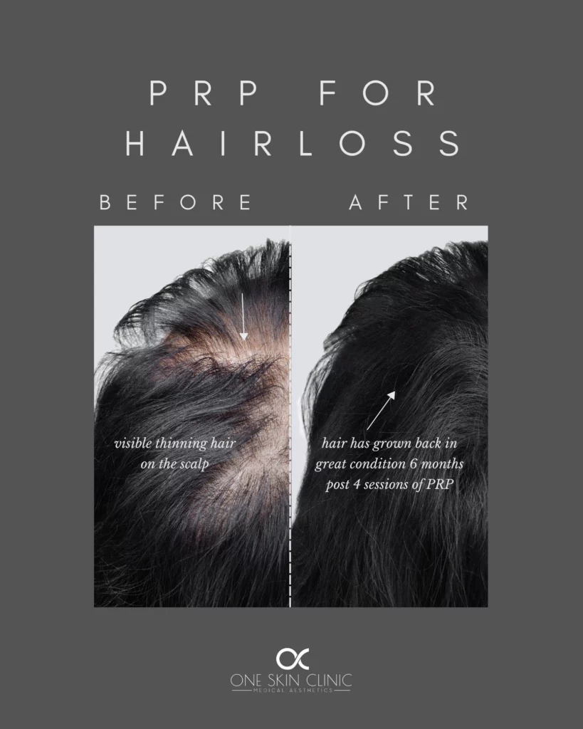 PRP Treatment Skin Treatment, Harley Street, Cosmetic Surgery